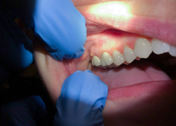 Best Broken or Chipped Tooth Repair in East Palestine, OH